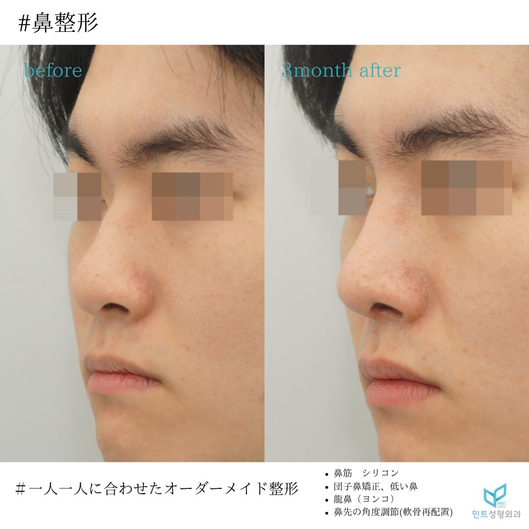 mintpskr's tweet photo. 🍀ミント整形外科🍀

👃鼻手術

✔鼻筋　シリコン
✔団子鼻矯正
✔低い鼻
✔龍鼻（ヨンコ）
✔鼻先の角度調節（軟骨再配置）

ヨンコ、団子鼻の部分が改善され、男性らしい高さのあるキレのあるお鼻になりました👏

＃龍鼻　＃ヨンコ　＃鼻フル　＃渡韓整形
＃鼻フル韓国　＃自然な鼻　＃メンズ整形 https://t.co/wXOsPbNlYx