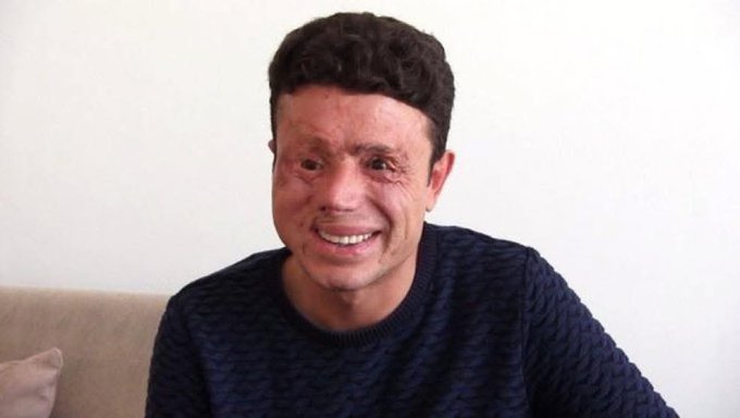damlatory's tweet photo. Gözlerini ve yüzünü kaybetmesine rağmen gülüşünü asla kaybetmeyen Gazimiz Ramazan Güneş.  

🇹🇷 Türk Milleti size minnettardır! https://t.co/Vt2zD26Zy0