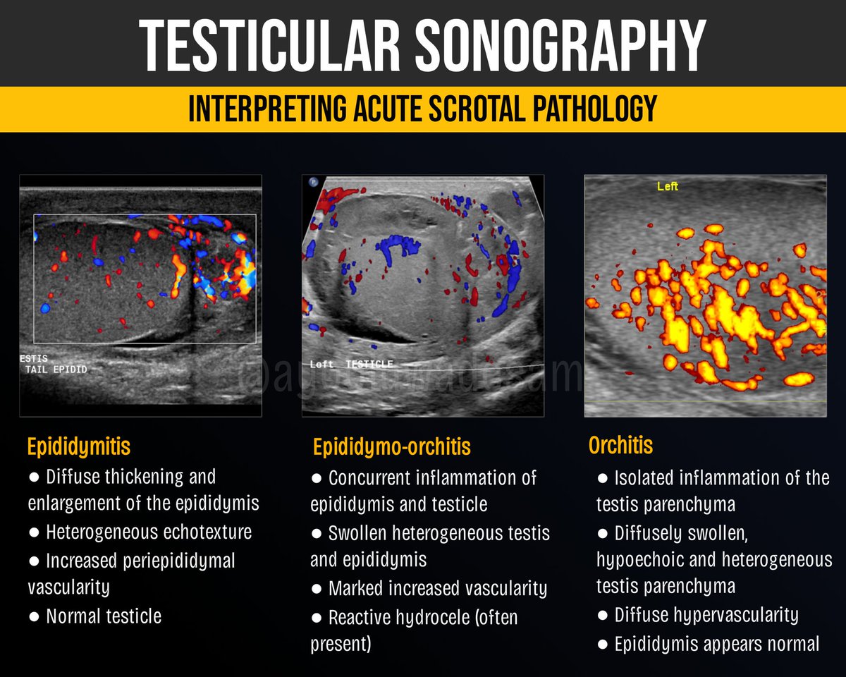 ayooluwadesam's tweet photo. EPIDIDYMITIS
EPIDIDYMO-ORCHITIS 
ORCHITIS 

Distinguishing between these three conditions relies on assessing whether the inflammation is confined, shared, or isolated?

See the  image below for key visual patterns to look out for in ultrasound. https://t.co/RANSnQf8ov