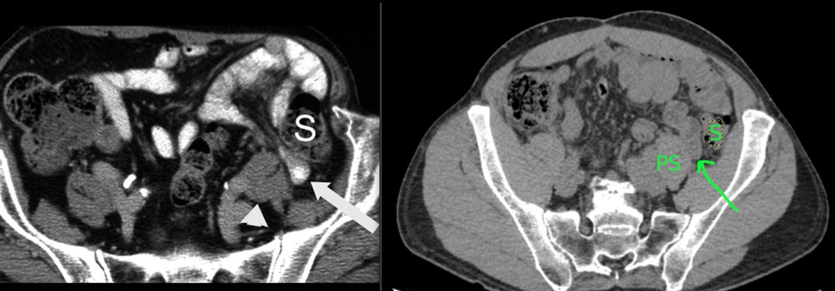 PeterShiff97416's tweet photo. @thecortexclub @RamVaidhyanath @MohitTCCNeuro @MCWNeurorad @APSHNRORG @ASHNRSociety @drjoshivarsha @BSHNI_UK @BshniTrainees @Radiopaedia @daniel_gewolb is this an internal hernia? thanks https://t.co/oANpJpHs1i