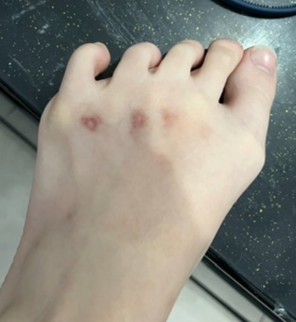 bluemingblo's tweet photo. Walau perlahan tapi bekas luka tahun lalu akhirnya hilang juga 🥹 https://t.co/YnVQjJyxeC