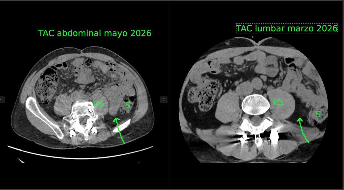 PeterShiff97416's tweet photo. @Dx_imaging @RadiologyACR @ARRS_Radiology @RSNA @Heart_SCCT @SNM_MI is this an internal hernia? thanks https://t.co/kCnqIyDhW8
