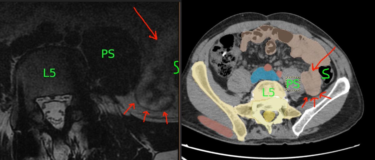 PeterShiff97416's tweet photo. @Dx_imaging @RadiologyACR @ARRS_Radiology @RSNA @Heart_SCCT @SNM_MI is this an internal hernia? thanks https://t.co/kCnqIyDhW8