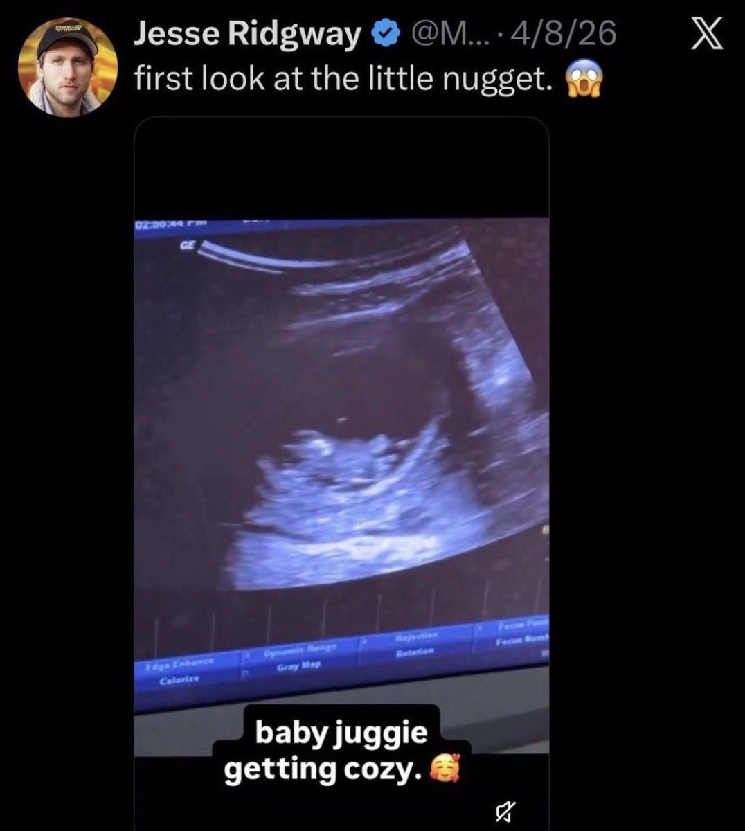 _LauraKlassen's tweet photo. Sorry little nugget… you had Down Syndrome. https://t.co/4iR6Dr221M