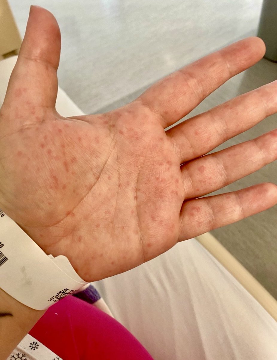 AngeeGabs's tweet photo. @JackieSeidel1 I started getting splotchy marks on my hands multiple times a week after a COVID infection. Had to go through multiple doctors telling me it was anxiety before getting a palmar erythema diagnosis and POTS diagnosis last week. Psychosomatic endometriosis is wild though! https://t.co/C5wnskhFcE