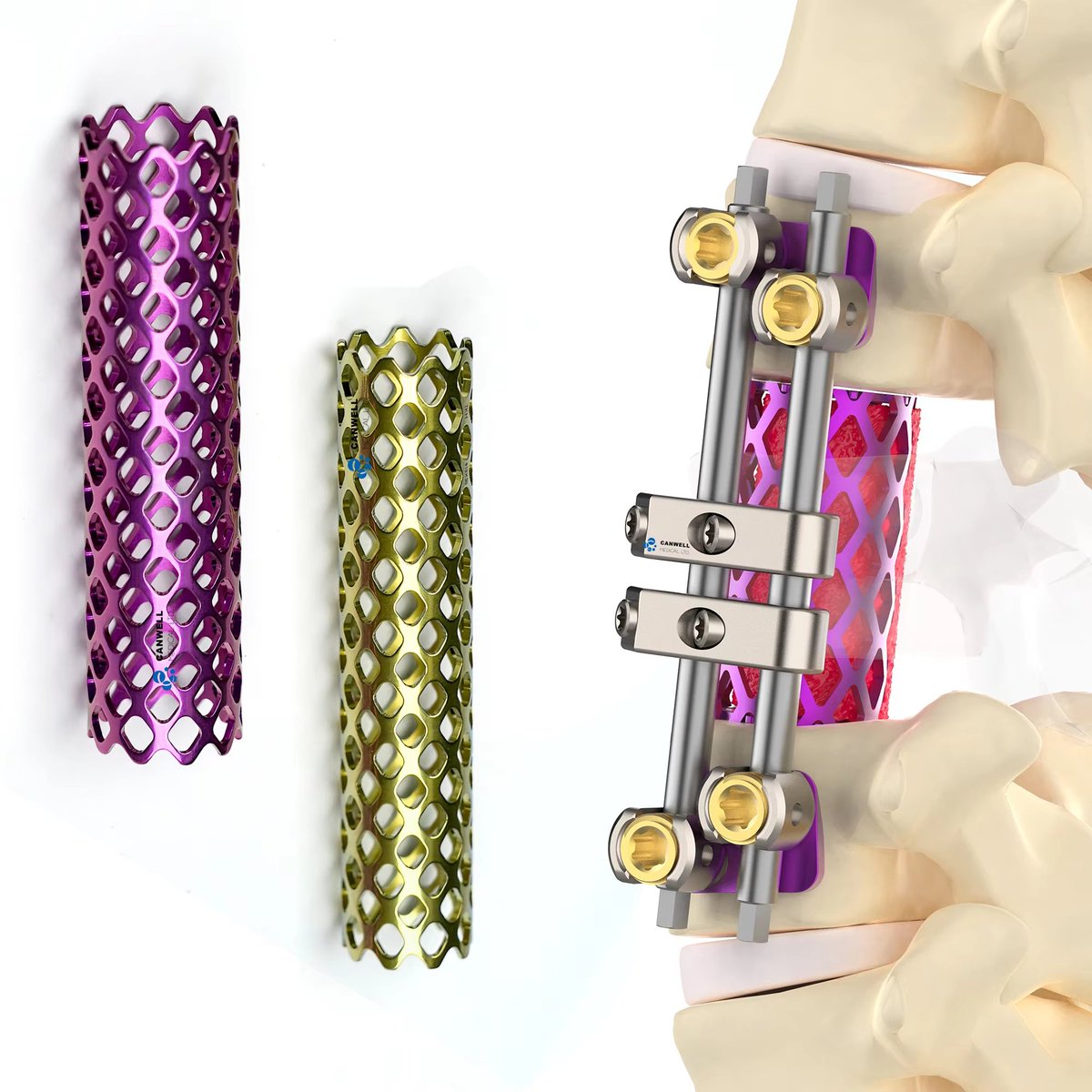LtdCanwell's tweet photo. Titanium Spine Mesh Cage | Thoracolumbar Pedicle Screw | Polyaxial Reduction | Minimally Invasive Spine Surgery
Precision-engineered spinal solutions designed for stability, versatility, and surgical efficiency. https://t.co/MaIdF7a32V