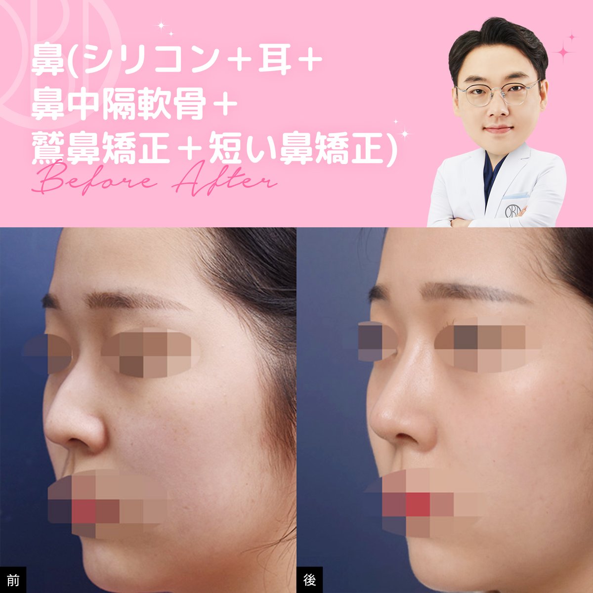 objetps_jp's tweet photo. オブジェ整形外科🧸

[手術内容]
鼻整形

💌お問い合わせ 
https://t.co/K2BvrmX2bC

#韓国整形 #鼻フル #小鼻縮小 https://t.co/Qps8wIGDgO