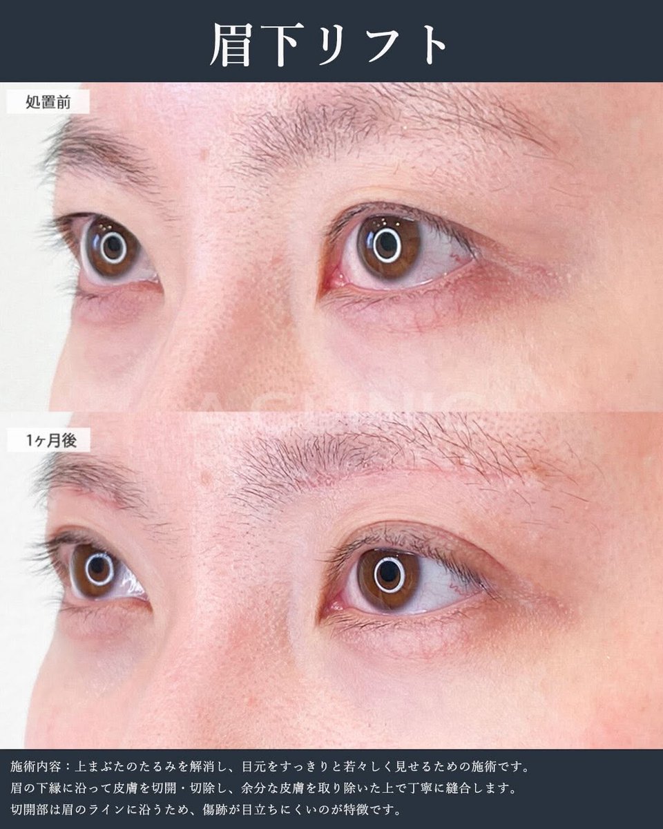 ACLINICOFFICIAL's tweet photo. 「最近まぶたが重い…」「眠そうに見える…」 
それ、上まぶたのたるみが原因かも😣

眉下リフトなら、元の二重や目の印象を大きく
変えずに、たるみだけをすっきり解消✨

目元の厚ぼったさがなくなって、パッと見開きの良い
キレイな目元に仕上がります💖 https://t.co/4ZOYI5cra2