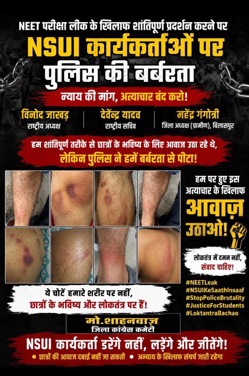 khansohrab06's tweet photo. NSUI के पूर्व जिलाध्यक्ष शाहनवाज़ ख़ान के उपर पुलिस की बर्बरता ।@bhupeshbaghel @DeepakBaijINC @_vikasupadhyay @Devendra_1925 @TS_SinghDeo @ChhattisgarhCMO @nsui @DrCharandas @RahulGandhi https://t.co/DbCJgy6zZz