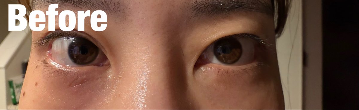 yn__jm's tweet photo. @fact_psjp 手術前のbeforeとafter(当日)です
悩み
・もともとの涙袋のなさから中顔面が長く見えることと、印象がキツく見えること。
・目の下の脂肪のかたより？による老け見え。

私の場合ですが、手術当日は、赤みがありましたが痛みもなく、翌日には赤みもかなり引いていました。 https://t.co/H00VZ8nMyT