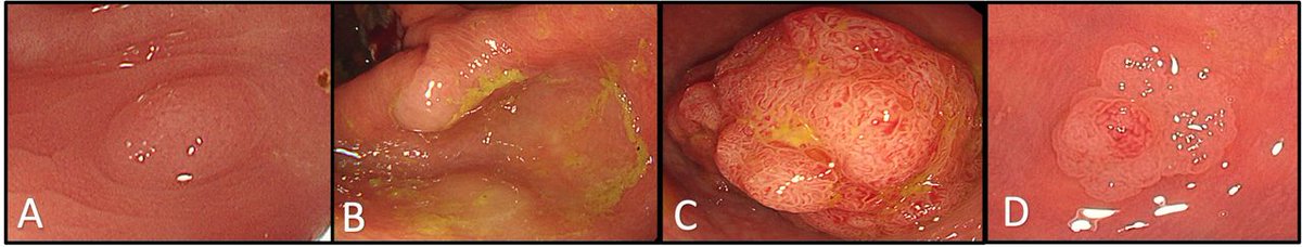FrontGastro_BMJ's tweet photo. 🔍 Serrated polyposis syndrome: what you need to know

SPS is the most common colorectal polyposis syndrome — but remains underdiagnosed due to subtle serrated lesions.

Key messages:

⚠️ Increased CRC risk
👀 Detection requires careful inspection
🖥️ HD imaging + chromoendoscopy can help
✂️ Cold snare for most non-dysplastic lesions <10 mm
📅 Surveillance remains variable — annual after clearance, with emerging data supporting selected 2-year intervals

A practical update for endoscopists on detection, resection and surveillance.

🔗 https://t.co/xjKPsyJGmd

#FrontlineGastroenterology #Endoscopy #Colonoscopy #SerratedPolyps #CRC

@PhilSmithIsBack @OTavabie @dr_aditi_kumar @TrevorTabone @eathar_s @IrenePerezMD @KGananandan @zare_benjamin @medicalreg @dtleiberman  @BSGtrainees @WorldGastroOrg @ulstergastro @SEEDendoscopia @EASLedu @AmCollegeGastro @Aegastro @SAGES_updates @WAGE_media @my_UEG @amergastroassn @NASPGHAN @UHSEndoscopy @ESGE_news @amergastroassn @BritSocGastro @ASGEendoscopy