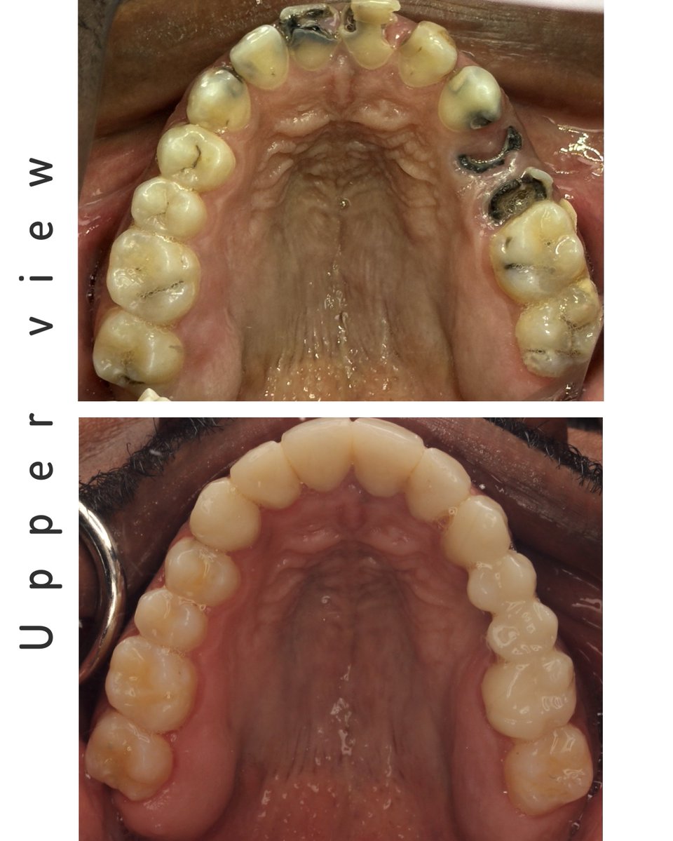 00vhy's tweet photo. Full Mouth Rehabilitation Case
(Total Patient Care) 5th year

Disciplines Involved: Periodontics, Oral Surgery, Endodontics, Fixed Prosthodontics, and Restorative Dentistry.

Chief Complaint (CC):
I have pain on the upper left and lower left side, and I would like to restore my teeth.

Patient Considerations:
The patient presents with an anterior open bite. Orthodontic treatment was discussed however, the patient is unable to afford the cost and does not wish to undergo orthodontic treatment in the future. Therefore the treatment plan was developed within these limitations.