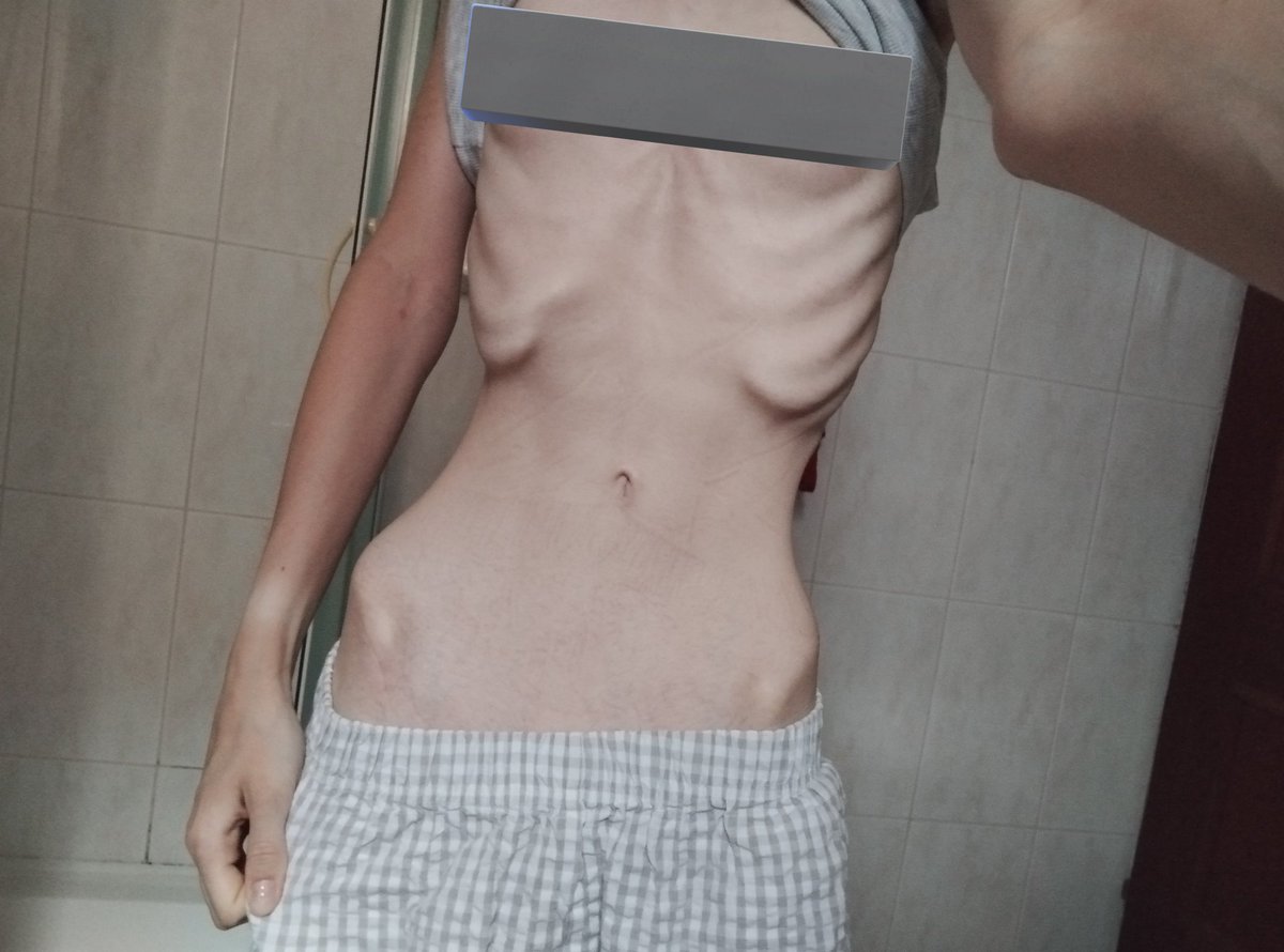 bluestjay_'s tweet photo. @lilmanbigdick This was my bmi low 12 so id guess  like bmi11/12  MAX bmi13 https://t.co/ugIVPh3drS