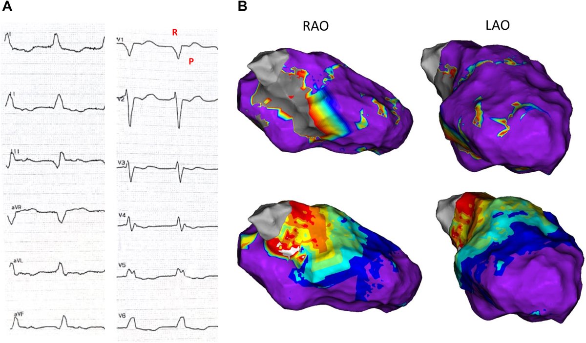 HRS_CaseReports's tweet photo. Successful ablation of incessant narrow-QRS ventricular tachycardia involving the His–Purkinje system: Insights from manifest entrainment 
https://t.co/WaZlOOYmlp https://t.co/yGHbpDklNh