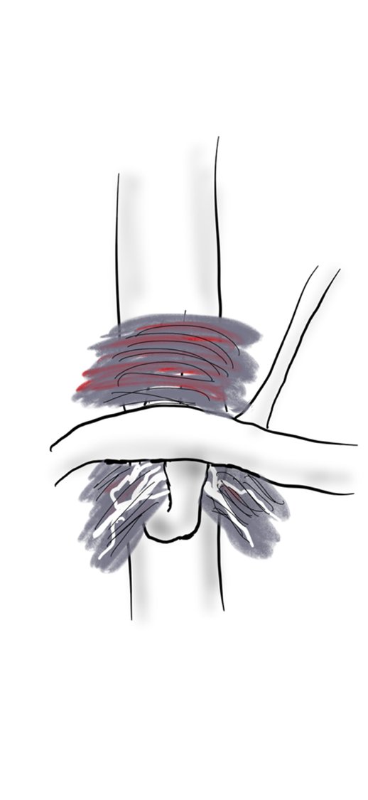 docpark's tweet photo. If you know, you know #MALS #medianarcuateligamensyndrome #vascsurg https://t.co/T4FzXXSv4P
