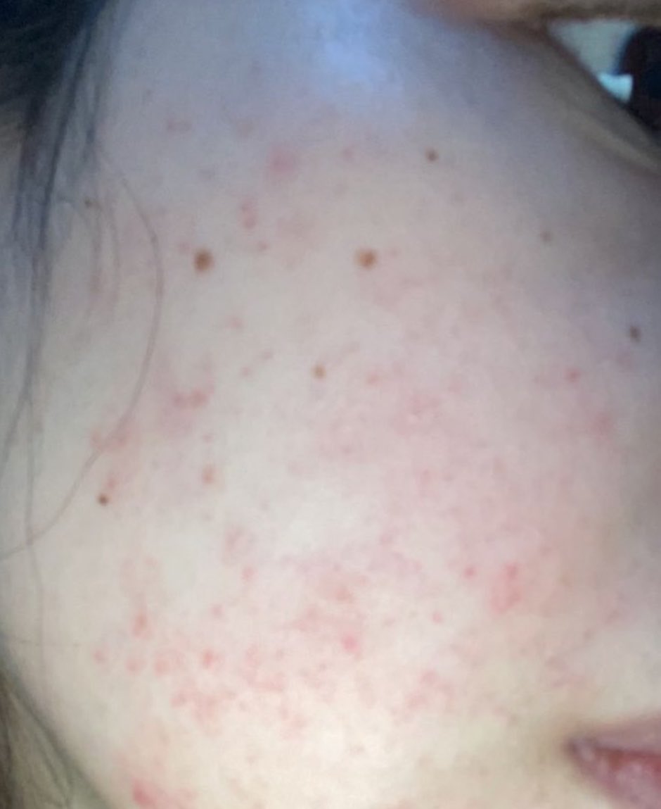 venggk's tweet photo. Gak nyesel ngumpulin duit buat beli skincare ini tapi hasilnya puass bangett🫶🏻
Dari kusam yang begini, bisa jadi bersih dan mulus gini🥰 https://t.co/qa0XkUocG0