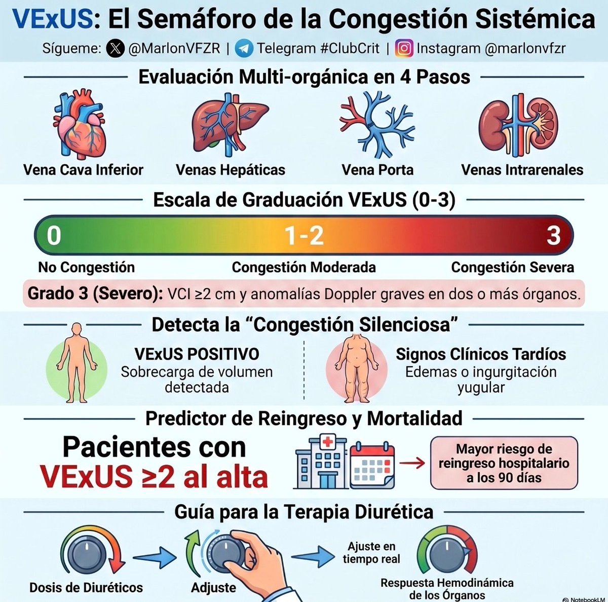 MarlonVFZR's tweet photo. 🫀🌊𝗩𝗘𝘅𝗨𝗦 𝗲𝗻 𝗶𝗻𝘀𝘂𝗳𝗶𝗰𝗶𝗲𝗻𝗰𝗶𝗮 𝗰𝗮𝗿𝗱𝗶𝗮𝗰𝗮🚨
@MDPIOpenAccess
👇🏼👇🏼👇🏼👇🏼
📑🔗🔑🔓
https://t.co/89ht2mBRSA
⬇️⬇️⬇️⬇️
🧵👇

La 𝙘𝙤𝙣𝙜𝙚𝙨𝙩𝙞𝙤́𝙣 𝙧𝙚𝙨𝙞𝙙𝙪𝙖𝙡 predice reingreso y mortalidad en IC, y la exploración física, la PVC o incluso la VCI aislada son imprecisas.
👉 𝙑𝙀𝙭𝙐𝙎 integra 𝙑𝘾𝙄 + 𝘿𝙤𝙥𝙥𝙡𝙚𝙧 𝙫𝙚𝙣𝙤𝙨𝙤 𝙝𝙚𝙥𝙖́𝙩𝙞𝙘𝙤, 𝙥𝙤𝙧𝙩𝙖𝙡 e 𝙞𝙣𝙩𝙧𝙖𝙧𝙧𝙚𝙣𝙖𝙡 para graduar la sobrecarga venosa sistémica.  

🧠 𝙀𝙡 𝙘𝙤𝙣𝙘𝙚𝙥𝙩𝙤 𝙛𝙞𝙨𝙞𝙤𝙥𝙖𝙩𝙤𝙡𝙤́𝙜𝙞𝙘𝙤 𝙚𝙨 𝙥𝙤𝙩𝙚𝙣𝙩𝙚: 𝙡𝙖 𝙘𝙤𝙣𝙜𝙚𝙨𝙩𝙞𝙤́𝙣 𝙫𝙚𝙣𝙤𝙨𝙖 𝙣𝙤 𝙨𝙤𝙡𝙤 “𝙖𝙘𝙤𝙢𝙥𝙖𝙣̃𝙖” 𝙖 𝙡𝙖 𝙄𝘾, 𝙩𝙖𝙢𝙗𝙞𝙚́𝙣 𝙙𝙖𝙣̃𝙖 𝙤́𝙧𝙜𝙖𝙣𝙤𝙨
El aumento de presión auricular derecha y venosa central se transmite hacia atrás y produce:
🫘 𝙘𝙤𝙣𝙜𝙚𝙨𝙩𝙞𝙤́𝙣 𝙧𝙚𝙣𝙖𝙡 → empeora filtración y diuresis
🫀 𝙨𝙞́𝙣𝙙𝙧𝙤𝙢𝙚 𝙘𝙖𝙧𝙙𝙞𝙤𝙧𝙧𝙚𝙣𝙖𝙡
🫁 congestión global peor tolerada
🧬 peor pronóstico
👉 El problema no es solo bajo gasto; muchas veces el gran enemigo es la 𝙝𝙞𝙥𝙚𝙧𝙩𝙚𝙣𝙨𝙞𝙤́𝙣 𝙫𝙚𝙣𝙤𝙨𝙖 𝙨𝙞𝙨𝙩𝙚́𝙢𝙞𝙘𝙖.  

📊 𝙑𝙀𝙭𝙐𝙎 𝙨𝙚 𝙞𝙣𝙩𝙚𝙧𝙥𝙧𝙚𝙩𝙖 𝙚𝙣 𝙪𝙣𝙖 𝙚𝙨𝙘𝙖𝙡𝙖 𝙨𝙞𝙢𝙥𝙡𝙚, 𝙥𝙚𝙧𝙤 𝙘𝙤𝙣 𝙢𝙪𝙘𝙝𝙖 𝙛𝙞𝙨𝙞𝙤𝙡𝙤𝙜𝙞́𝙖 𝙙𝙚𝙩𝙧𝙖́𝙨
📍 𝙂𝙧𝙖𝙙𝙤 𝟬: VCI no dilatada
📍 𝙂𝙧𝙖𝙙𝙤 𝟭: VCI dilatada + sin patrones Doppler severos
📍 𝙂𝙧𝙖𝙙𝙤 𝟮: VCI dilatada + 𝟭 𝙥𝙖𝙩𝙧𝙤́𝙣 𝘿𝙤𝙥𝙥𝙡𝙚𝙧 𝙨𝙚𝙫𝙚𝙧𝙤
📍 Grado 3: VCI dilatada + ≥2 patrones severos
Los hallazgos severos incluyen:
🔁 reversa sistólica en vena hepática
〰️ pulsatilidad portal >50%
🌑 flujo venoso intrarrenal monopásico diastólico

📉 𝙀𝙣 𝙄𝘾, 𝙪𝙣 𝙑𝙀𝙭𝙐𝙎 𝙖𝙡𝙩𝙤 𝙨𝙚 𝙖𝙨𝙤𝙘𝙞𝙖 𝙘𝙤𝙣 𝙥𝙚𝙤𝙧 𝙝𝙚𝙢𝙤𝙙𝙞𝙣𝙖́𝙢𝙞𝙘𝙖, 𝙥𝙚𝙤𝙧 𝙧𝙞𝙣̃𝙤́𝙣 𝙮 𝙥𝙚𝙤𝙧𝙚𝙨 𝙙𝙚𝙨𝙚𝙣𝙡𝙖𝙘𝙚𝙨
Los estudios resumidos en la revisión muestran que grados altos de VExUS se correlacionan con:
⬆️ 𝙥𝙧𝙚𝙨𝙞𝙤́𝙣 𝙖𝙪𝙧𝙞𝙘𝙪𝙡𝙖𝙧 𝙙𝙚𝙧𝙚𝙘𝙝𝙖
⬆️ 𝙥𝙧𝙚𝙨𝙞𝙤𝙣𝙚𝙨 𝙙𝙚 𝙡𝙡𝙚𝙣𝙖𝙙𝙤 𝙞𝙯𝙦𝙪𝙞𝙚𝙧𝙙𝙖𝙨
🫘 𝙙𝙞𝙨𝙛𝙪𝙣𝙘𝙞𝙤́𝙣 𝙧𝙚𝙣𝙖𝙡 / 𝘼𝙆𝙄 / 𝙢𝙚𝙣𝙤𝙧 𝙚𝙛𝙞𝙘𝙞𝙚𝙣𝙘𝙞𝙖 𝙙𝙞𝙪𝙧𝙚́𝙩𝙞𝙘𝙖
🏥 más reingresos
☠️ mayor mortalidad intrahospitalaria y a corto plazo
👉 No es solo una imagen “bonita”; parece capturar carga congestiva clínicamente relevante.  

🎯 𝙏𝙖𝙠𝙚-𝙝𝙤𝙢𝙚: 𝙑𝙀𝙭𝙐𝙎 𝙣𝙤 𝙧𝙚𝙚𝙢𝙥𝙡𝙖𝙯𝙖 𝙡𝙖 𝙘𝙡𝙞́𝙣𝙞𝙘𝙖, 𝙡𝙖 𝙘𝙤𝙢𝙥𝙡𝙚𝙢𝙚𝙣𝙩𝙖 𝙮 𝙥𝙪𝙚𝙙𝙚 𝙧𝙚𝙛𝙞𝙣𝙖𝙧 𝙚𝙡 𝙛𝙚𝙣𝙤𝙩𝙞𝙥𝙤 𝙙𝙚 𝙘𝙤𝙣𝙜𝙚𝙨𝙩𝙞𝙤́𝙣
Se recomienda usarlo junto con:
🫁 𝙪𝙡𝙩𝙧𝙖𝙨𝙤𝙣𝙞𝙙𝙤 𝙥𝙪𝙡𝙢𝙤𝙣𝙖𝙧
🫀 ecocardiografía
🧪 biomarcadores
👨‍⚕️ exploración clínica
Especialmente útil en:
✅ ingreso
✅ seguimiento intrahospitalario
✅ alta
✅ monitoreo ambulatorio
⚠️ Pero aún hay límites: dependencia del operador, confusores como IT severa, FA, hepatopatía, ventilación mecánica, y falta de grandes ensayos de manejo guiado por VExUS.

🔥 Mensaje final: 𝙑𝙀𝙭𝙐𝙎 𝙚𝙨 𝙪𝙣𝙖 𝙝𝙚𝙧𝙧𝙖𝙢𝙞𝙚𝙣𝙩𝙖 𝙢𝙪𝙮 𝙥𝙧𝙤𝙢𝙚𝙩𝙚𝙙𝙤𝙧𝙖 𝙥𝙖𝙧𝙖 𝙤𝙗𝙟𝙚𝙩𝙞𝙫𝙖𝙧 𝙘𝙤𝙣𝙜𝙚𝙨𝙩𝙞𝙤́𝙣 𝙫𝙚𝙣𝙤𝙨𝙖 𝙨𝙞𝙨𝙩𝙚́𝙢𝙞𝙘𝙖 𝙚𝙣 𝙄𝘾, 𝙥𝙚𝙧𝙤 𝙩𝙤𝙙𝙖𝙫𝙞́𝙖 𝙙𝙚𝙗𝙚 𝙫𝙚𝙧𝙨𝙚 𝙘𝙤𝙢𝙤 𝙘𝙤𝙢𝙥𝙡𝙚𝙢𝙚𝙣𝙩𝙤 𝙢𝙪𝙡𝙩𝙞𝙢𝙤𝙙𝙖𝙡, 𝙣𝙤 𝙘𝙤𝙢𝙤 𝙢𝙖𝙧𝙘𝙖𝙙𝙤𝙧 𝙖𝙞𝙨𝙡𝙖𝙙𝙤 𝙙𝙚𝙛𝙞𝙣𝙞𝙩𝙞𝙫𝙤.  

‼️Si te sirve: ❤️ Me gusta | 🔁 Repost | ➕ Follow para más👇🏼👇🏼👇🏼👇🏼
📚📖#ClubCrit👨🏻‍⚕️👨🏻‍🏫🧠🫶

📚📖 Más en el blog 👉 [https://t.co/HUCnQ3Pi7l]

#HeartFailure #VExUS #POCUS #CardiorenalSyndrome #Congestion #HF #IC #VenousCongestion #Ultrasound #Hemodynamics #AKI #DiureticResistance #AcuteHF #POCUS #FOAMed #FOAMcc #CriticalCare #CriticalCare #CuidadoCrítico #MedTwitter #CritCare #icu #intensivecare #diagnosis #management #UCI #MedicinaBasadaEnEvidencia #MedEd #MedX #IntensiveCare #MedIntensiva #MedXCommunity #MedED #ICUmanagement #MustRead #LecturaRecomendada