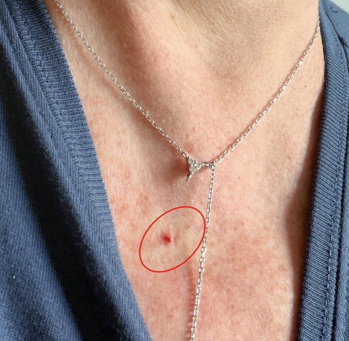 Bella__Bahby's tweet photo. My friend just pulled this tick off his chest 😳🕷️. 

Does anyone know if this is a deer tick nymph? https://t.co/tH0NZsXhNL