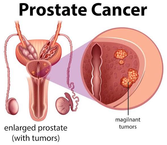 ayurveda_shyam's tweet photo. Prostate health support!

A healthy diet rich in tomatoes,  pumpkin seeds, fish, and vegetables may help support prostate health.

Regular exercises,  staying hydrated, and maintaining a healthy weight are also beneficial. 

Eat 1-2 tbs pumpkin seeds daily and include cooked tomatoes in your meals.

These provides nutrients and antioxidants that support normal prostate function. 

Persistent urinary symptoms should be evaluated by a healthcare professional.