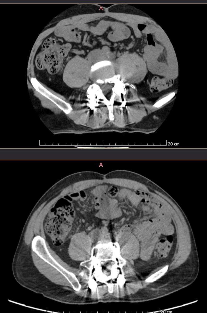 PeterShiff97416's tweet photo. @IhabFathiSulima is that an internal intermetint hernia? https://t.co/Vr14EQwsD4