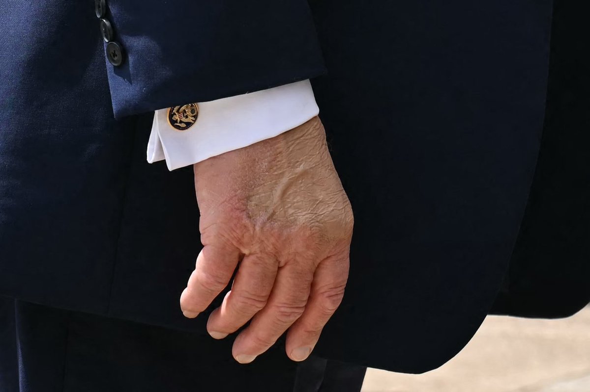 atrupar's tweet photo. a look at the back of Trump's right hand as he briefly spoke to reporters in Wisconsin

i'm not sure what's happening here, but aspirin and too much hand-shaking ain't it

(Saul Loeb/Getty) https://t.co/kvJ5d9XMbC
