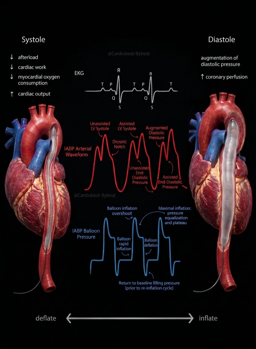 CardioBeat_'s tweet photo. https://t.co/1L8Vk85rcR
Systole: ↓ afterload, ↑ CO. Diastole: ↑ coronary perfusion. 📉 The IABP waveform alignment explained. #Cardiology #Hemodynamics https://t.co/o9RRXrU6Ks