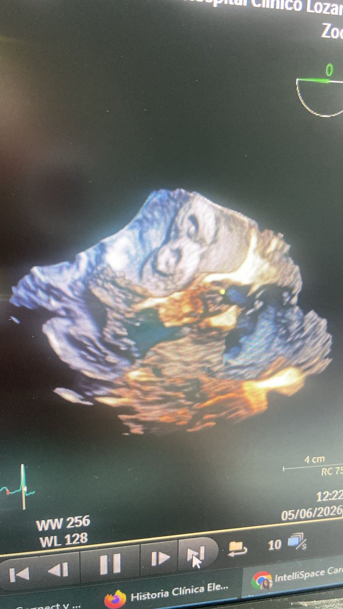 AntonelaLukicOt's tweet photo. Excellent ASD workshop today with two challenging cases, including a multi-fenestrated ASD closed with a double-device strategy. Thanks to Dr. Felipe Hernández for sharing his expertise, Abbott and GE HealthCare. Great imaging with the Vivid Pioneer platform. #Amplatzer https://t.co/MDMfd7cR1J