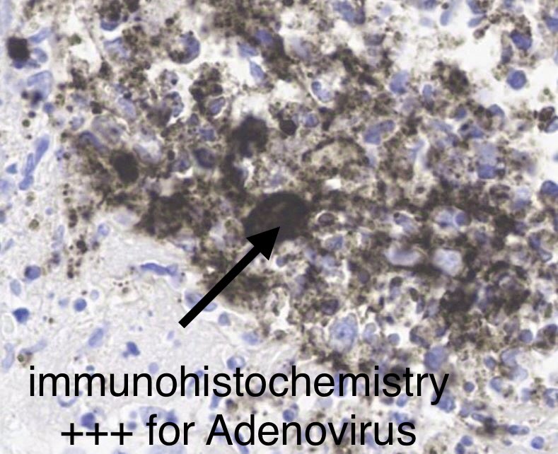 SethiRenalPath's tweet photo. Kidney biopsy: Great teaching case

Severe inflammation and necrosis with abscess formation.

Look carefully=you see cells with large nuclei in the mix of inflammatory cells.

IHC= Positive staining for ADENOVIRUS.

DX: Adenovirus-associated interstitial nephritis.

55-yr old with kidney &
heart transplant, fevers, rise in serum creatinine.