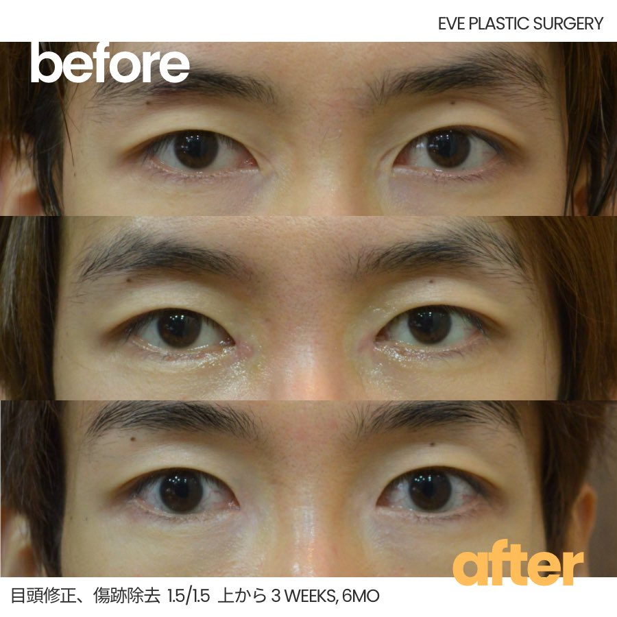 EvePlastic's tweet photo. 【男性の目頭修正 Before→After📸】

「目と目が近くなりすぎた気がする…」
「目つきがキツく見られるようになった…」

そんなお悩みでご相談いただく男性も少なくありません。

目頭切開後のバランスを整え、
やさしく自然な印象の目元へ✨

✔ 目と目の距離感が気になる
✔ 不自然な目頭を改善したい
✔ よりナチュラルな印象にしたい

30年以上にわたり目元手術を専門に行ってきたチョン先生が、一人ひとりのお目元の状態に合わせてご提案いたします👨🏻‍⚕️✨

ご相談・お問い合わせは下記リンクより📩
https://t.co/Vw8uTEbCnA

#目頭修正 #目頭切開修正 #男性整形 #修正手術 #韓国整形 #イブ整形外科 #目頭再建 #蒙古襞形成 #修正手術 #男性整形 #整形相談 #自然な目元