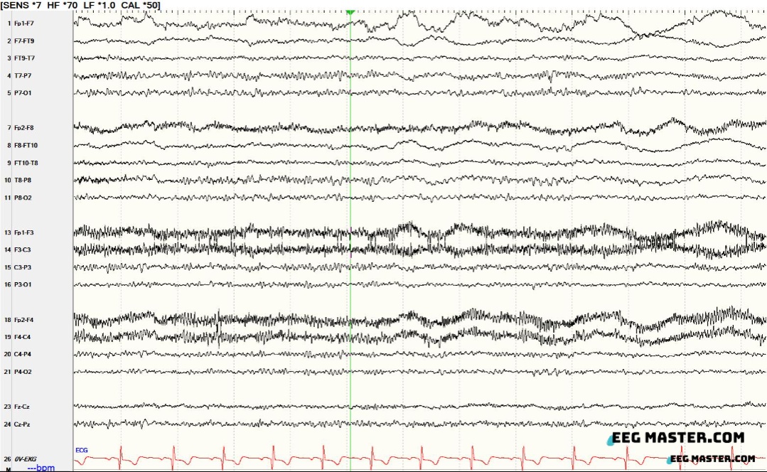 eeg_master's tweet photo. 32 M, alert with no neurologic symptoms. What is the most likely explanation for the following EEG?
A. Focal slowing
B. Medication 
C. Non-convulsive status
D. Hypoxic injury
E. Generalized epileptiform discharges

Answer @ https://t.co/LcP1L7p52h https://t.co/t8QxRdW75C