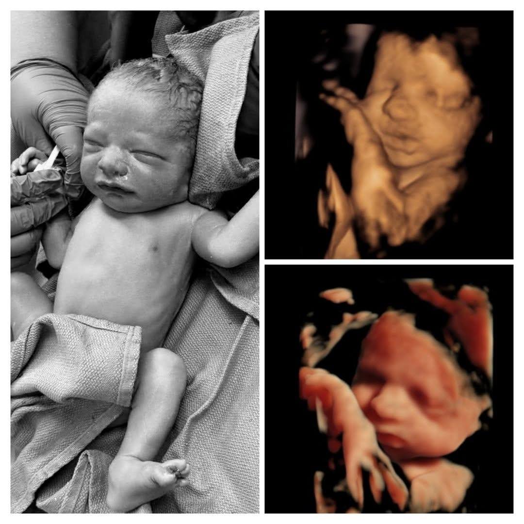 LiveAction's tweet photo. Same baby inside the womb and out — with the same right to life.

It is a horrific tragedy that moments before birth, this little one could have been legally killed in 9 states + D.C.

Every child deserves to live.

Ban abortion now.

📸: @The4DLady https://t.co/rEgluEjSAn