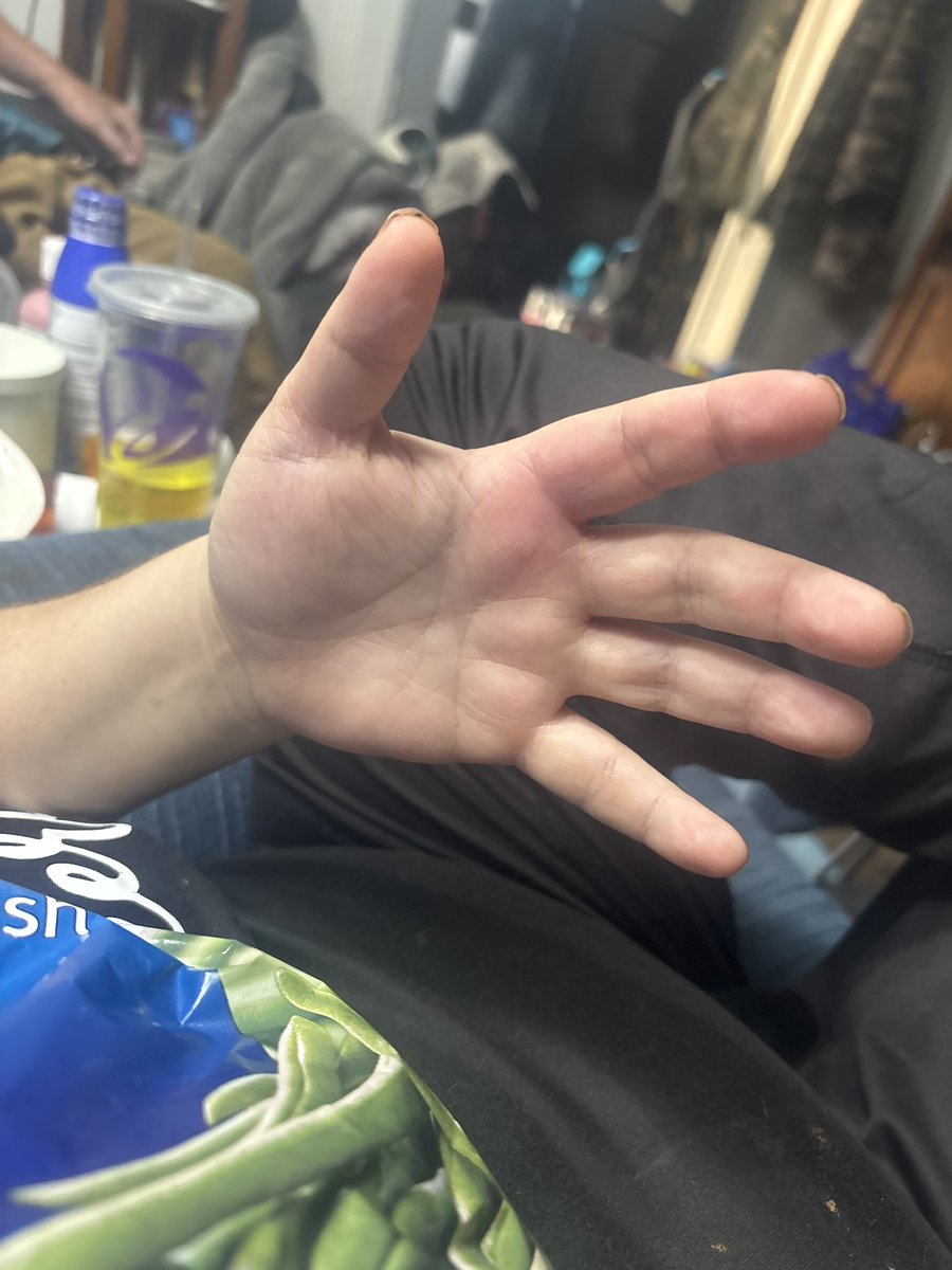 ItsSoLinz's tweet photo. Pictures of my mom’s hand where the leash wrapped around her fingers during the fight.
It was completely numb for over an hour, she couldn’t bend or straighten her fingers without intense pain. You can see how swollen it was after being on ice (frozen green beans) for 45 minutes. https://t.co/fATeoC5mV6