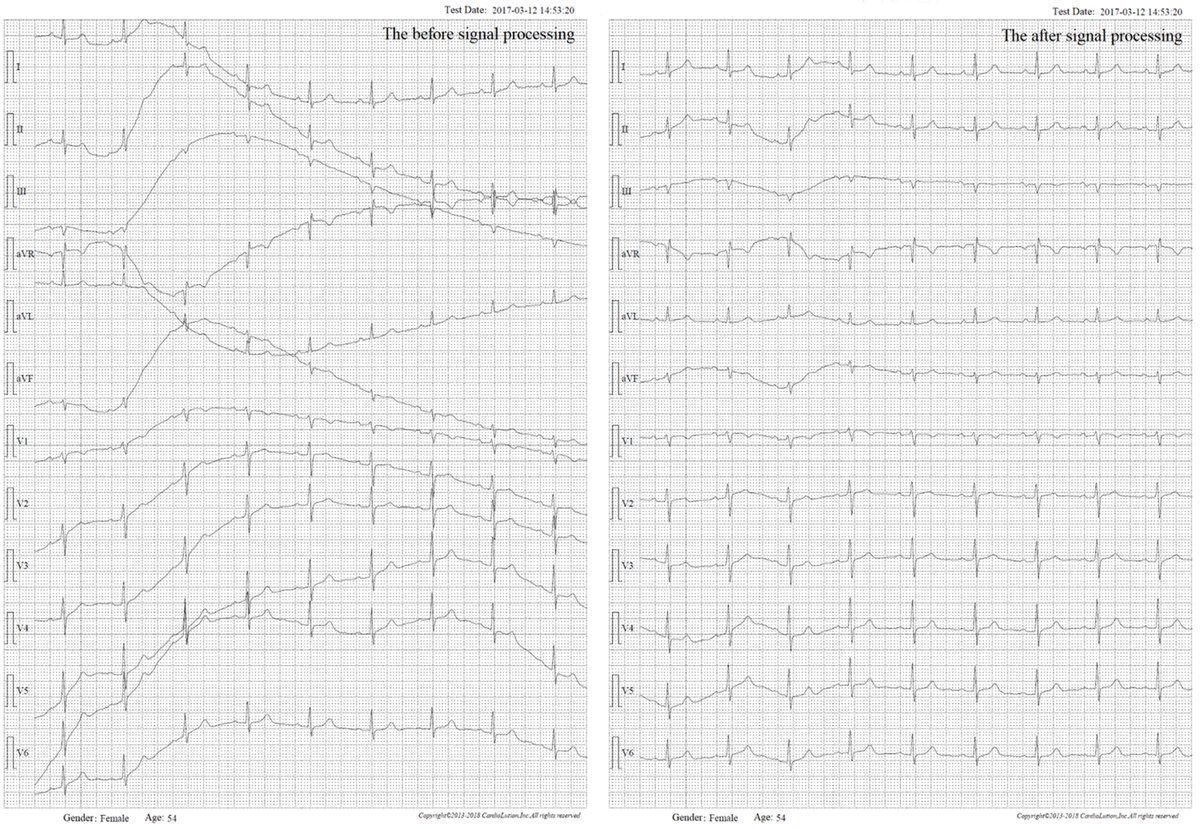 physiosign's tweet photo. New Generation of Vital Sign Monitoring 
Patent number: 12239448  

Why Are Monitors Susceptible to Interference Drift? 

Monitors are designed for continuous 24-hour operation. However, the polarization voltage on the human body’s surface is highly prone to interference. In enclosed environments over extended periods, this voltage becomes unstable, making signal drift inevitable and unavoidable.  

At PhysioSign, we have developed a patented technology for processing electrical signals that completely eliminates drift—regardless of its intensity, even when it exceeds the baseline. This breakthrough is unique worldwide and the only solution of its kind.  

This patented innovation revolutionizes traditional monitors by enabling true 24-hour dynamic ECG monitoring. It represents a groundbreaking advancement in electrocardiography—120 years after its invention—fully resolving one of the most persistent and difficult challenges in the field.

The conventional trio of parameters (ECG, NIBP, and SpO₂) often falls short in critical care. Their delayed response to changes in vital signs can hinder timely intervention.   

The new generation of monitors changes this paradigm. They can detect diseases before they fully manifest, at their earliest onset, or during intermittent episodes. These systems deliver automatic, intelligent warnings—without requiring constant manual oversight by doctors and nurses, especially during nighttime hours.  

Notably, the new monitors excel at identifying high-risk conditions such as: 
Myocardial infarction without typical ECG changes Acute coronary syndrome (ACS) 
Atrial fibrillation combined with myocardial infarction Conduction block with myocardial infarction  

They provide continuous, vigilant protection, enabling proactive care before emergencies arise. In addition, the integration of non-invasive cardiac function and cardiac output monitoring (without intubation) dramatically expands clinical utility.   

Since the invention of vital sign monitors in 1957, this marks the first major reinvention in the field. Powered by a groundbreaking “image/data/AI” automation framework, these monitors are entering a new era—delivering higher accuracy, intelligence, and clinical value than ever before. 

Most importantly: 
New vital sign monitoring can now provide early warnings for potential sudden cardiac events up to 2 weeks in advance.  
 
✅ECG, SpO₂, NIBP, RR, HR, Temperature   
✅New Electrophysiological Imaging   
✅Early Detection of: Heart Failure and/or Acute 
✅Myocardial Infarction (AMI)
✅Acute Coronary Syndrome (ACS)
✅Infarct-avid myocardial imaging
✅Complete Right Bundle Branch Block (CRBBB) with AMI
✅Complete Left Bundle Branch Block (CLBBB) with AMI
✅Atrial Fibrillation (A-fib) with AMI
✅Latent lesions prior to sudden cardiac death
✅Wellens Syndrome
✅de Winter Syndrome
✅Sgarbossa Syndrome

💡Advanced Insights:
✅Non-invasive cardiac output (CO) monitoring based on Frank-Starling Law curve
✅Invasive electrophysiology data: PA, AH, and HV intervals
✅Detection of AMI and OMI even when standard ECG appears normal

PhysioSign

#signalprocessing
#vitalsignmonitoring