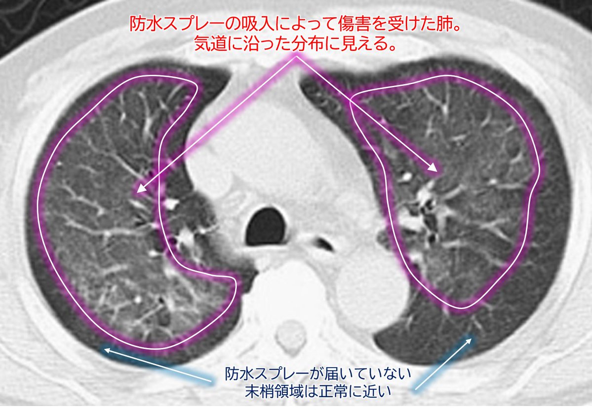 lungdrnote's tweet photo. 指導医「解説です。

防水スプレーの吸入で発症する急性の肺障害です。
スプレーに含まれる霧状の撥水成分、特にフッ素系成分によって肺胞に障害をきたすことが主な病態と考えられています。

半年前に登山用品への防水スプレー使用について投稿しましたが、今回も梅雨入りが近づき、雨具に防水スプレーを使用する機会が増えそうです。

同様の事故やトラブルが起こる可能性がありますので、使用時は十分ご注意ください。

防水スプレーは、雨具、登山用品、コート、靴など、日常生活やアウトドア製品に広く使用されていますが、狭く換気の悪い場所で使用すると本病態を発症する危険性があります。

症状の出現時期は吸入量にもよりますが、吸入後数分から24時間以内に発症することが多く、咳嗽、咽頭痛、呼吸困難などを呈します。
重症例では呼吸不全に至ることもあります。
また、スプレー吸入後の喫煙が発症や重症化に関与することが報告されています。

画像：
胸部CTは「足側から見上げるビュー」なので、「画像の左側＝患者さんの右肺」「右側＝患者さんの左肺」になります。
吸入による肺障害では、気管支・気道に沿ったすりガラス影・浸潤影・粒状影が出現しやすく（添付画像の赤線内）、一方で胸膜下では薬剤到達量が少ないため、比較的正常に見えることが多いという特徴があります。

本症例では、B先生が病歴聴取の際に有機溶剤様のにおいに違和感を覚え、詳細に問診した点が診断につながった点がお手柄です。

掲載している画像は、下記より引用
「日呼吸会誌 47（5），2009．367－371」