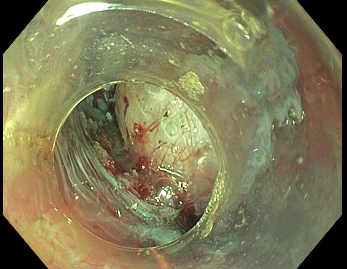GavricAle's tweet photo. First STER @GI_UMCLJ @ukclj

58-year-old woman presented with dysphagia and was referred to us by thoracic surgeons. A 25 mm esophageal leiomyoma was identified and successfully removed from the esophagus (22 cm from the incisors). https://t.co/nEMtTdyus5