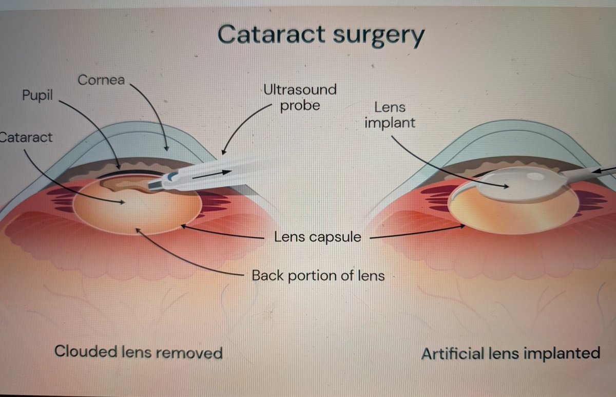 preeti_john's tweet photo. Our article in @_Anesthesiology "Preop Evaluation of Patients Undergoing #Cataract Surgery: Recommendations, Challenges, Ethical Considerations" @ASALifeline @ASAMonitor @HopkinsMedicine @aao_ophth @HopkinsACCM @bermaninstitute @VAsurgeons @BMJ_Ophth https://t.co/qGzCPjMf1Z https://t.co/xSpJ9sBw8y