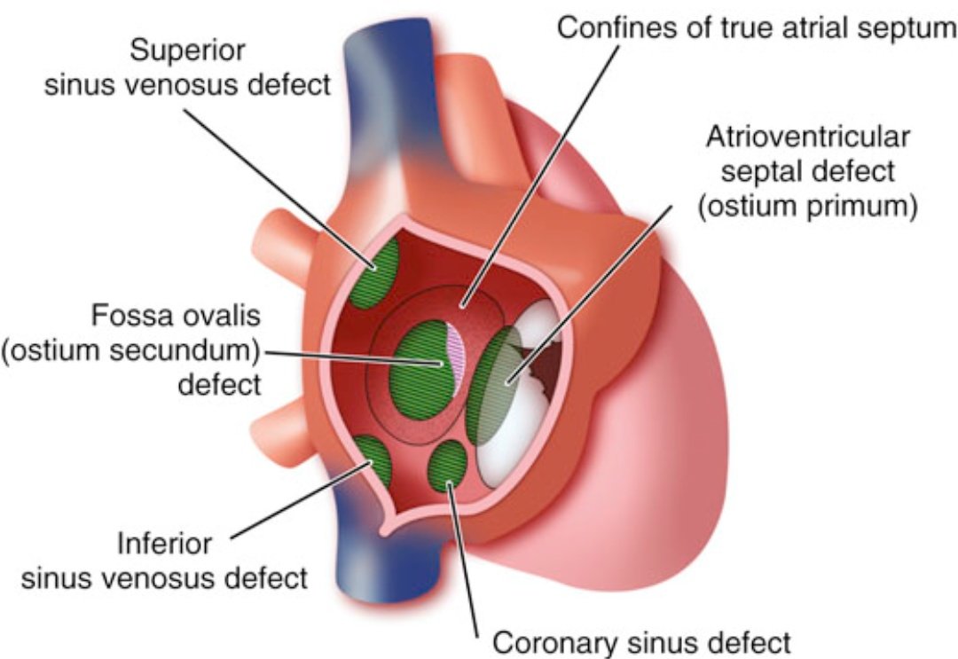 TrackYourHeart's tweet photo. Various atrial level shunts. https://t.co/LidQ3dQZes