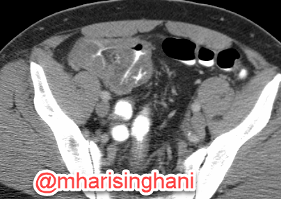 mharisinghani's tweet photo. Neutropenic colitis https://t.co/jXcEiXAy5N