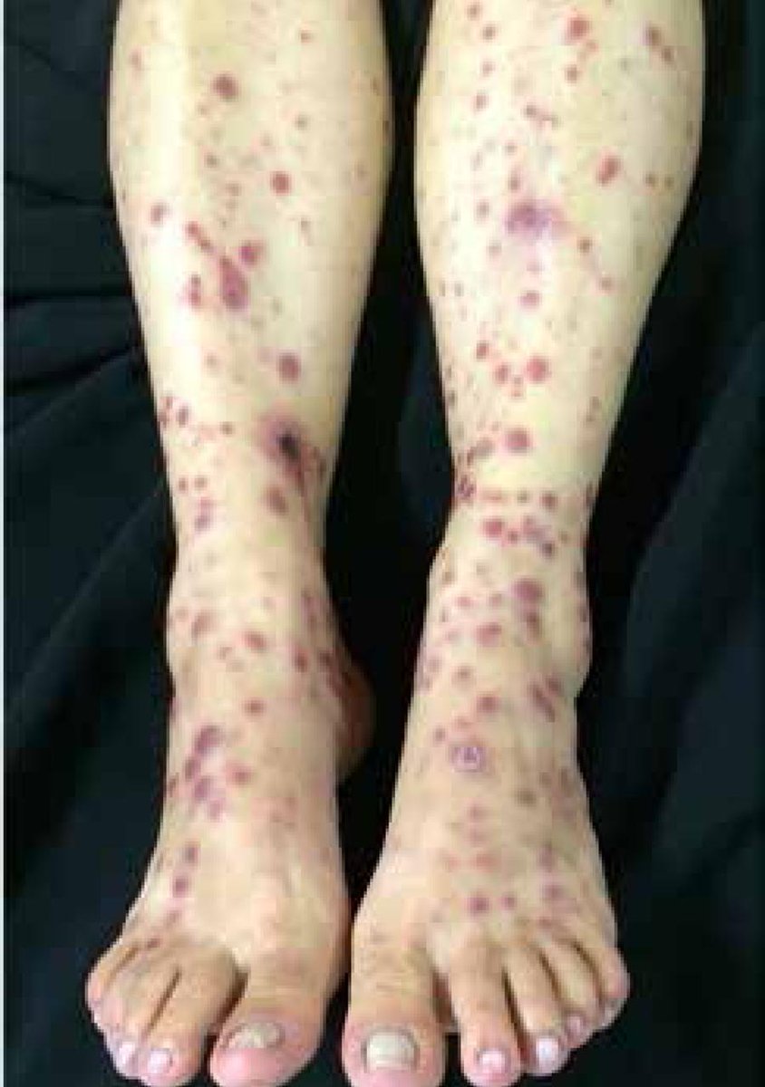 IhabFathiSulima's tweet photo. An HIV patient.
What type of Rash? https://t.co/a3tpHVQFPn