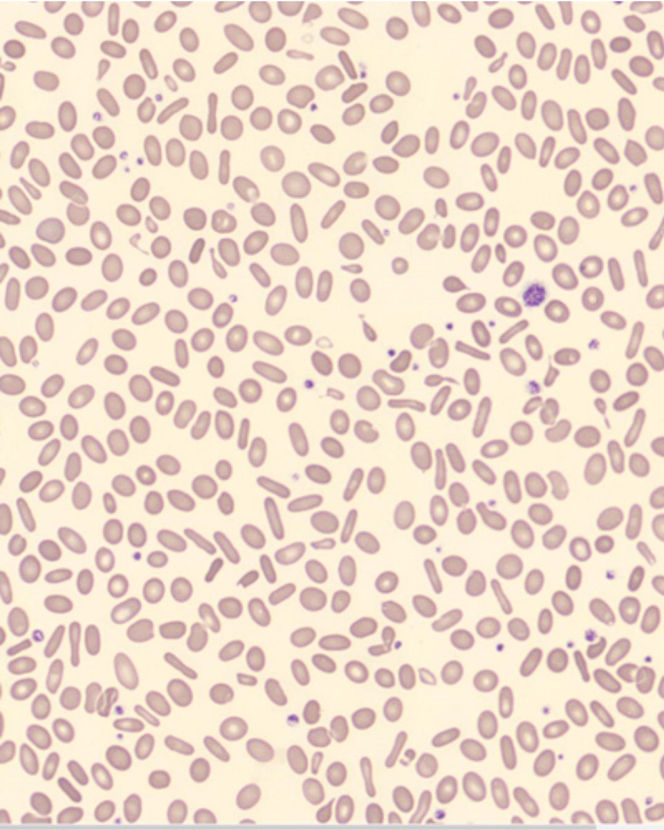 Semedlab's tweet photo. 🔎 Piropoiquilocitosis Hereditaria (PPH)

📖  La PPH es un subtipo poco frecuente de eliptocitosis hereditaria que deriva en una anemia hemolítica de intensidad variable.

Más info sobre la imagen de junio de Hematología 👉 https://t.co/yK7oj7bgZF https://t.co/lywo15DlfE