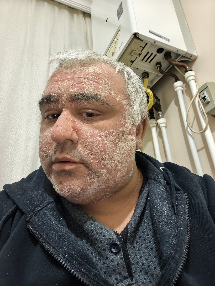 salomanya86's tweet photo. @albayimm001 Al sağlığın geldiği son nokta. 2020 yılında tedavim durduruldu. Son halim budur. Hakmı; ülke yerin altını hesaplayamayanlarla dolu. Ben biliyorum 6 yıldır ağrıdan nasıl aplayıp bitap düştüğümü https://t.co/8YrhkyJvif
