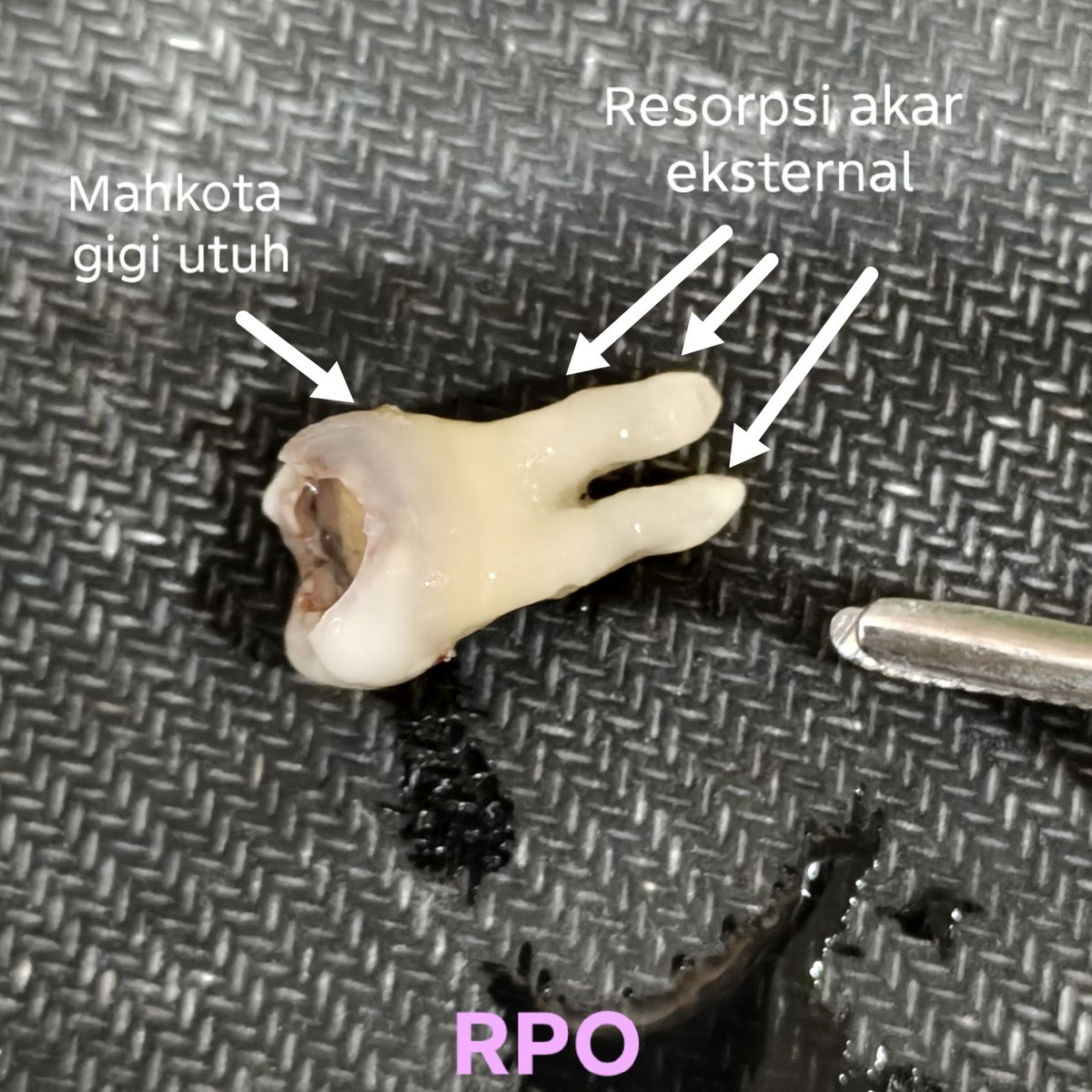 RakaiVDentist's tweet photo. Kemaren kita bahas polip gingiva, hari ini kita bahas kasus lama saya yang sekilas mirip tapi beda: polip pulpa. 

Pasien datang dengan keluhan daging tumbuh dari giginya. Sering berdarah, dan perih.

Perhatikan warna polip lebih merah dan mengkilap daripada gusi. artinya... https://t.co/YMh0VLzLDN