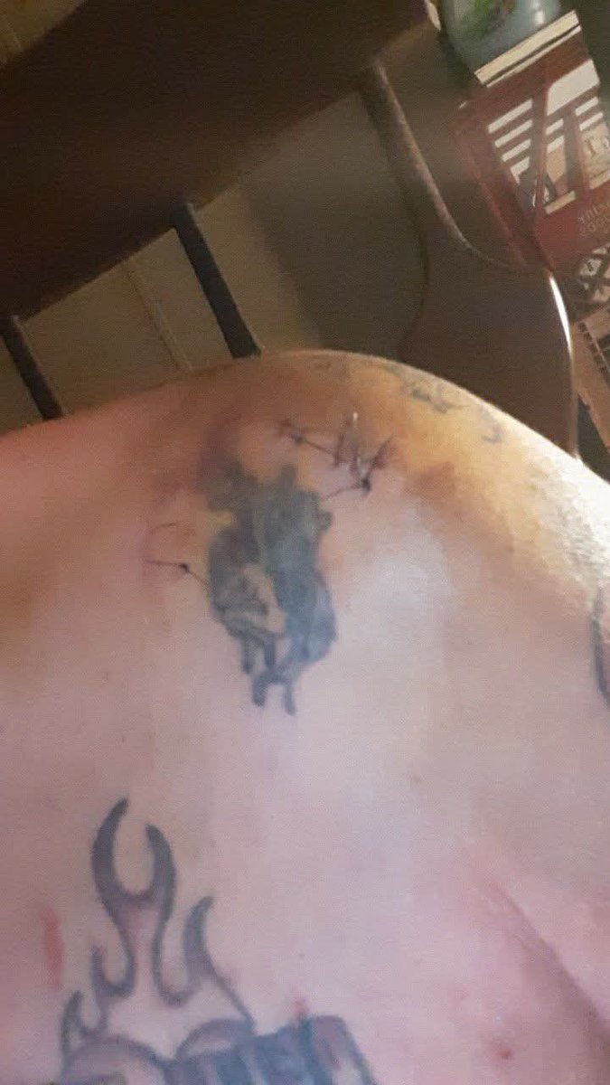 The1QOS's tweet photo. "What the Fuck Doc" 🤯😲😳 one little cut maybe an inch, On my back, Omfg, it's there too. 🤬🤬 It's Looking like Frankenstein's newest project 🤦🏻‍♀️🤦🏻‍♀️🤦🏻‍♀️#Detroit #OMFG #WTF #Frankenstein #DocExplainYourself https://t.co/u8t9drLKHe