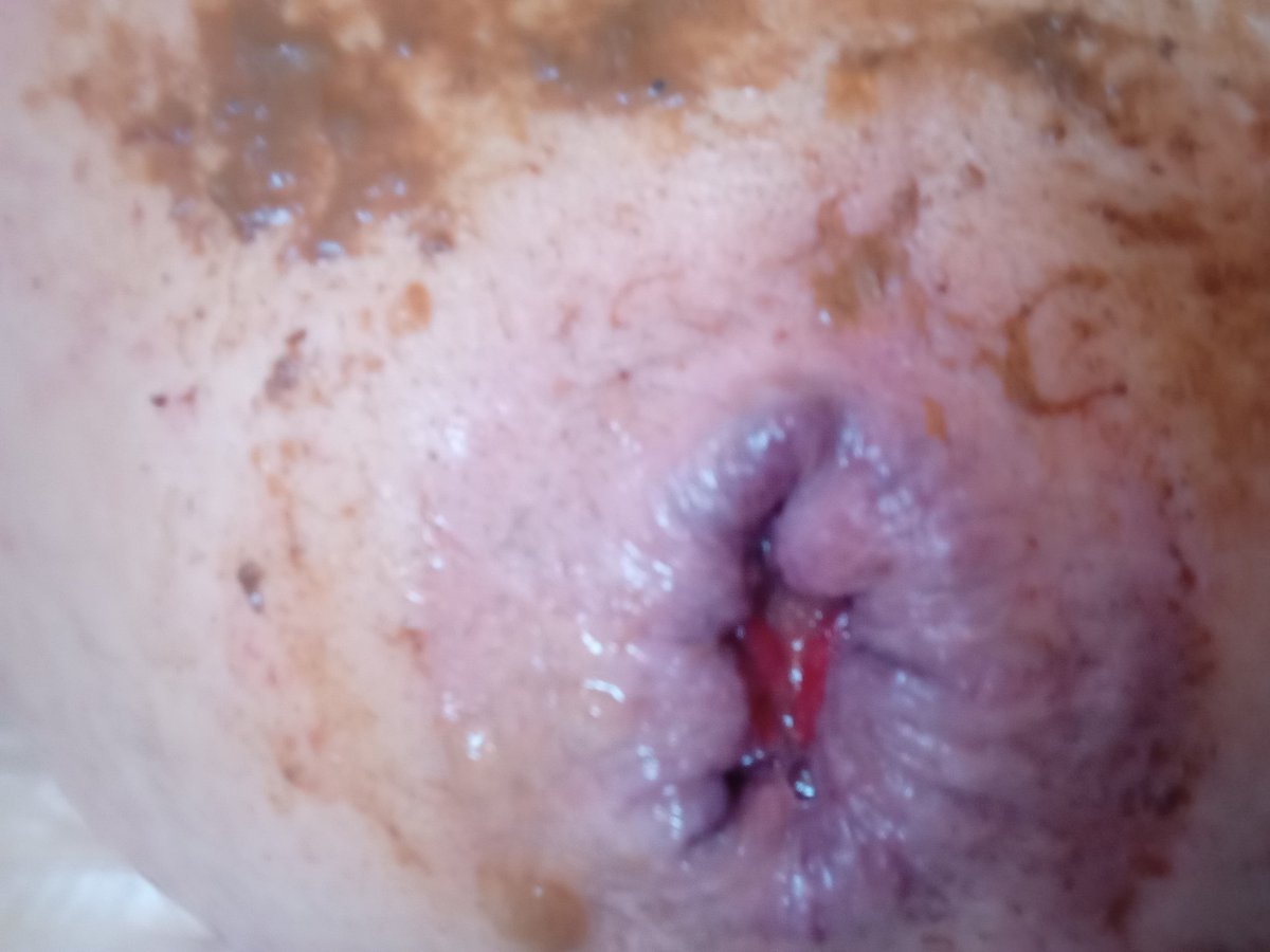 Piglet44Piglet's tweet photo. I love the progress❤️every morning inserted for two hours🫣i have to wear diapers or pads almost 24/7. My hole is still weak and leaking🏅#analgaping #ruined #incontinent #plugged #diaper https://t.co/rzjuJuzBvk