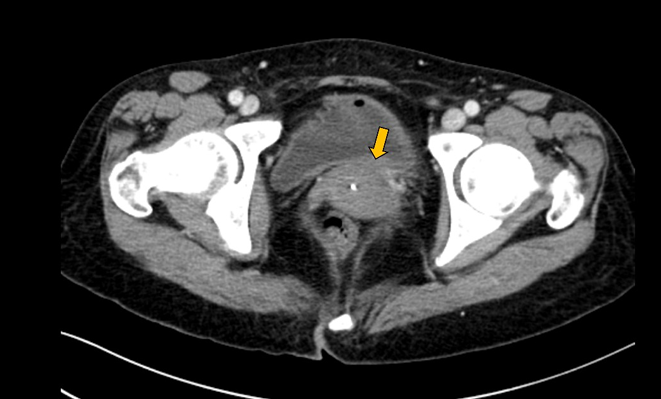 doctorneyro's tweet photo. #BE can occur in #postmenopausal in absence of #exogenousestrogen or #obesity.
The #livercirrhosis associated with impaired #estrogenmetabolism, #diabetes, characterized by #chronicinflammation, contribute to a #proinflammatory #microenvironment
https://t.co/pCEML4fbKK https://t.co/4LXjwKhryf
