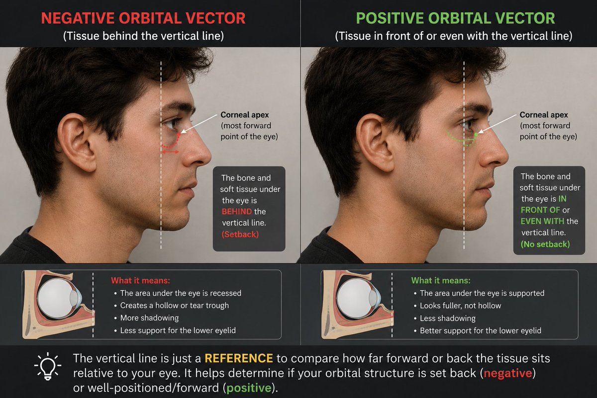 Recessed Infras Example What is the Infraorbital Rim and How To Tell If Yours Is Deficient The ...
