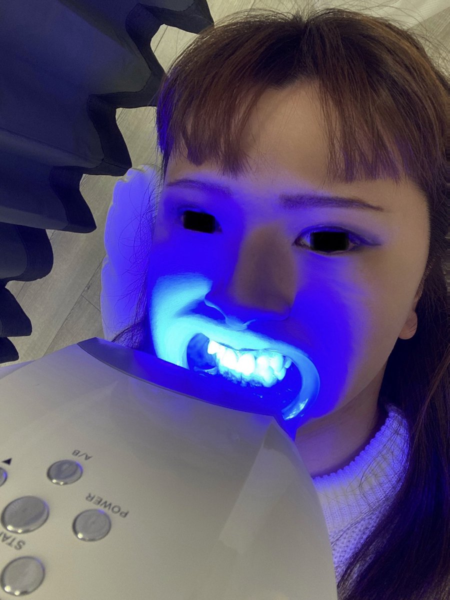 pic_teeth's tweet photo. セルフのホワイトニング風景と写真。
治療後色が変わらないようにメンテナンスとしている写真。

前後の比較は写真に収められています

#ホワイトニング
#開口器
#口腔内写真 https://t.co/K97H13DoVT