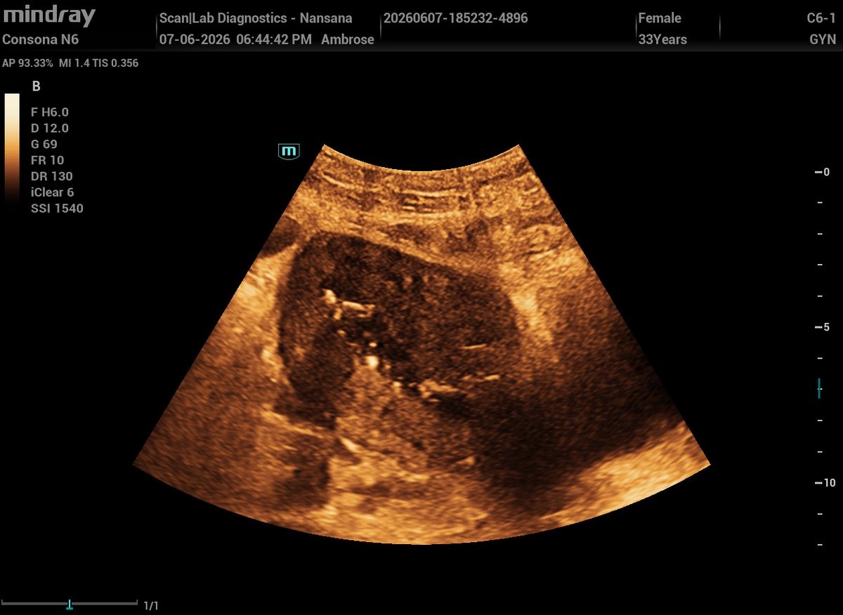 ambrose074's tweet photo. Ultrasound speaks. I interpret!
Post‑partum uterus (1 week post C/S)
Ultrasound findings:
Endometrial cavity contains fluid with multiple echogenic foci,
No internal vascularity on color Doppler,
Volume ≈10.5 c.
Are these 'normal' post-partum contents or RPOC?
Sonograms 👇👇 https://t.co/g8jj6Wl84Z