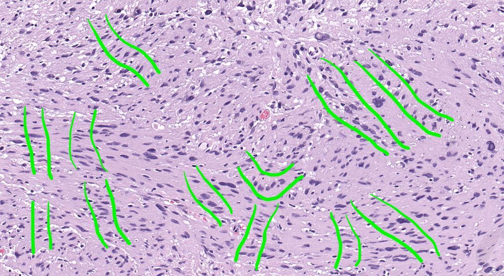 JMGardnerMD's tweet photo. Soft tissue mass. S100+. Diagnosis? 
Answer ✅ https://t.co/RLP2My4DDK
What am I highlighting with these green lines?
Explanation & more pics https://t.co/bj7B2HJ7cD 
WSI digital slide 🔬https://t.co/rxy2be8cLV 
#pathology #pathologists #pathTwitter #dermpath #dermatology #dermtwitter #BSTpath