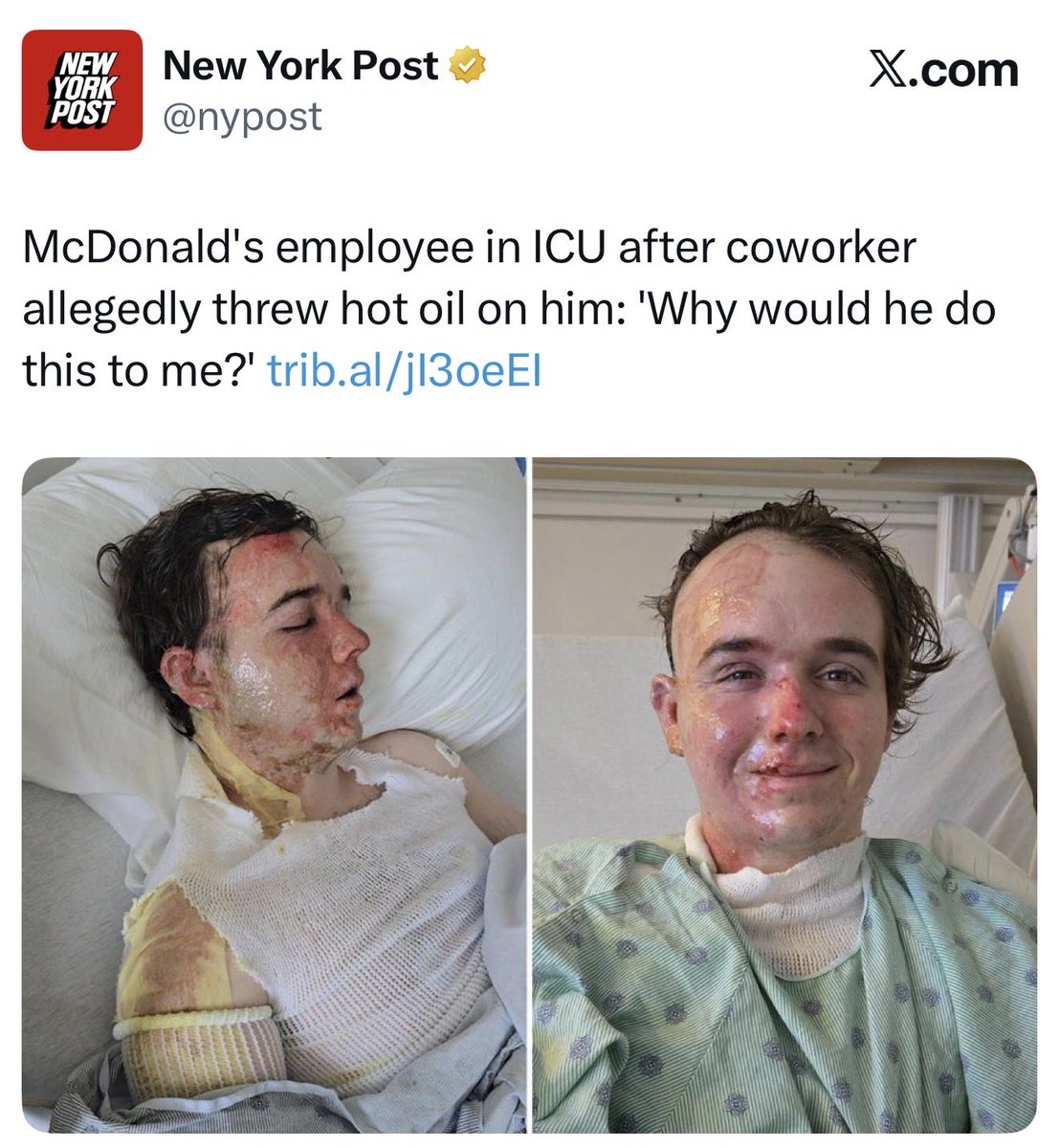 atensnut's tweet photo. 🚨McDonald’s employee in ICU after coworker poured hot oil on him.  Yes, victim is white and suspect is black.  

Senseless actions!    What would possess someone to be that cruel?    Victim will never be the same. https://t.co/INopKPlaHH